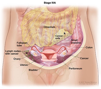 Ovarian Cancer Stage IIIA