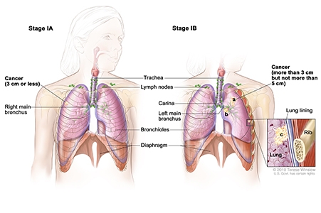 Lung Cancer, Non-Small Cell, Stage I