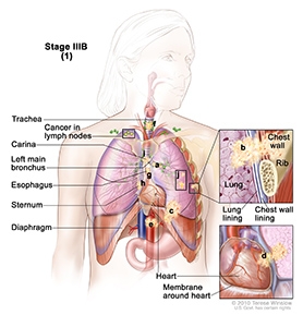 Lung Cancer, Non-Small Cell, Stage IIIB