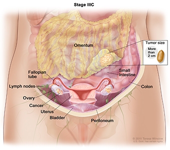 Ovarian Cancer Stage IIIC