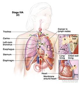 Non-Small Cell Stage IIIA Lung Cancer