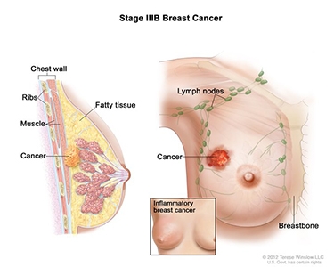 Image of 	Breast Cancer Stage IIIB
