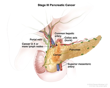 Pancreatic Cancer Stage 3