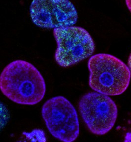 Human colorectal cancer cells treated with a combination of a topoisomerase inhibitor and an inhibitor of the protein kinase ATR 