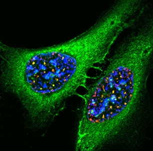 Osteosarcoma Cells