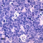 Malignant B-cell lymphocytes seen in Burkitt's lymphoma, stained with hematoxylin and eosin (H&E) stain.